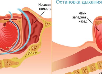 Какие заболевания вызывают остановку дыхания во сне